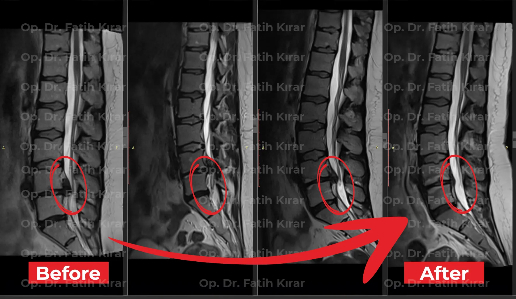 Spinal intervention MRI - Pre and post treatment